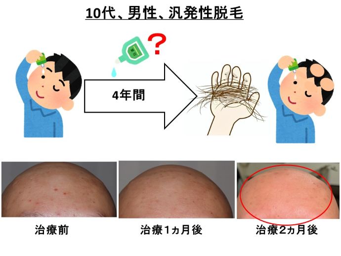 円形脱毛症　病院